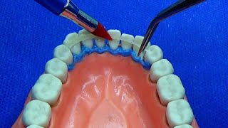 Ferulizar dientes con movilidad fibra de vidrio Interlig [upl. by Eyk]