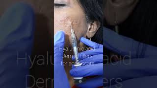 Hyaluronic filler injections for acne scars [upl. by Innoc]