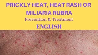 Prickly heat heat rash or miliaria rubra  Prevention amp treatment  Unani medicine  English [upl. by Euqinehs]