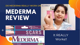 Mederma Cream Review for AcneBurn Scars and Stretch Marks [upl. by Naujaj]