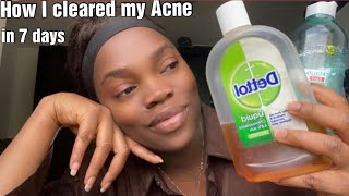 How I Cleared My Acne using Dettol linguid Chloroxyleno with Garnier my honest review [upl. by Gnaht]