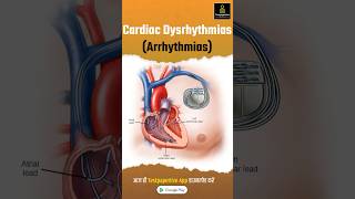 Cardiac Dysrhythmias Arrhythmia Part1  Types of Cardiac Arrhythmia Cardiac Dysrhythmias [upl. by Hearn260]