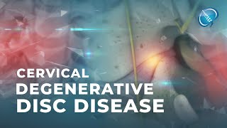 What is Cervical Degenerative Disc Disease  DDD [upl. by Esimaj772]