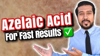 Azelaic Acid for Melasma  How to Use Azelaic Acid for SUCCESS 🏆 [upl. by Kwok]