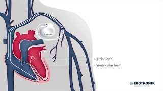 How pacemakers work  Medical Animation [upl. by Ringsmuth]