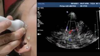 How To Transcranial Doppler [upl. by Maiga]