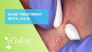 Acne Treatment amp Extractions on Julie  New Patient [upl. by Tracey357]