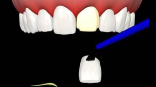 Como o dentista faz uma faceta de porcelana nos dentes [upl. by Lew]