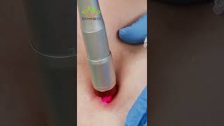 Laser Spider Vein Removal [upl. by Vinni]