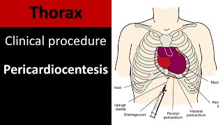 Pericardiocentesis I Anatomy of clinical procedure pulmonaryresidentessential6481 [upl. by Heather42]