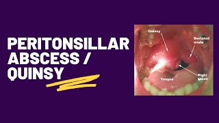 Peritonsillar abscess  Quinsy [upl. by Jerome]