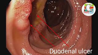 Duodenal ulcer l l endocut [upl. by Kella]