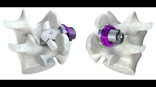 The Minuteman Procedure  Minimally Invasive Spinal Fusion [upl. by Berta]