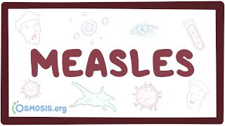 Measles  causes symptoms diagnosis treatment pathology [upl. by Flanagan]