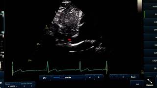 IVC view and measurment [upl. by Melly]