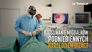 Usuwanie migdałków podniebiennych narzędziem BiZact [upl. by Ozkum]