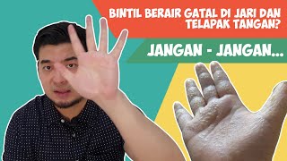 Jari tangankaki timbul Lenting Berair BERBAHAYA MENULAR Simak penjelasan dr Michael SpDV [upl. by Trilbie611]