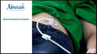 Home Tube Feeding for Children  Low Profile Feeding Tubes [upl. by Maer]