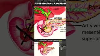 Pancreatitis Aguda por cálculos biliares doctor pancreatitis fisiopatologia [upl. by Anirtak675]