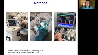 MRIgLITT thalamotomy for essential tremor  ESSFN 2021 [upl. by Atrebla]