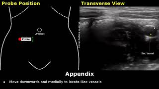 How To Scan Appendix  Ultrasound Probe Positioning  Transducer Placement  Abdominal USG Scanning [upl. by Nieberg]