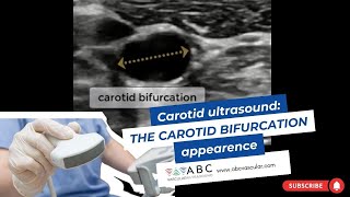 Understanding Your Carotid IMT Ultrasound Report [upl. by Teague]