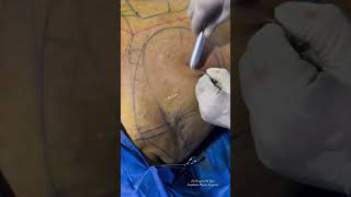 Laser Assisted Liposuction and Skin Tightening Dr Prajwal K Rao I Plastic Surgeon [upl. by Yerrot]