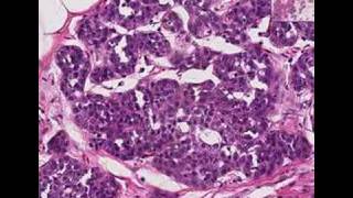 Histopathology Breast Lobular carcinoma in situ [upl. by Valera]