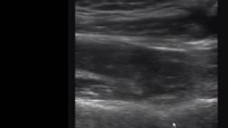 Suprascapular Nerve Block [upl. by Ressan]