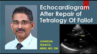 Echocardiogram After Repair of Tetralogy Of Fallot [upl. by Kerns]