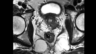 Prostate cancer with extracapsular extension [upl. by Bob958]