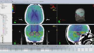 VMAT for hippocampalavoidance whole brain Radiotherapy [upl. by Yenolem]