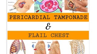 PERICARDIAL TAMPONADE amp FLAIL CHEST [upl. by Schrick528]