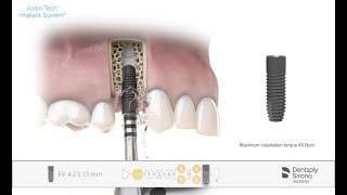 Implant installation Astra Tech Implant System EV [upl. by Ysset]