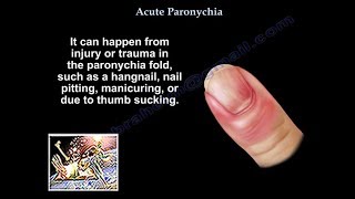 Paronychia  Everything You Need To Know  Dr Nabil Ebraheim [upl. by Heathcote688]