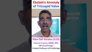 Ebsteins Anomaly of Tricuspid Valve [upl. by Margherita61]