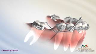 Orthodontic Treatment for Molar Uprighting  Cantilever Spring [upl. by Nadean154]