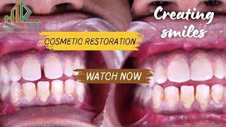 Dental Bonding Front Teeth  Cosmetic Restoration [upl. by Rafe]