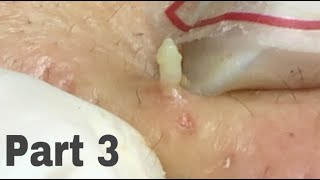 BYoung Spa  blackheads The biggest acne particles PART 3 [upl. by Granoff]