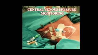 Central Venous Pressure Monitoring ProcedureCVP [upl. by Emmerich]