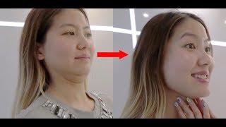 HIFU Shurink facelift and Lip Fillers  Seoul Guide Medical [upl. by Sikorski]