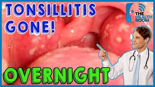 10 Effective Tonsillitis Home Remedies That Work Fast [upl. by Jolenta234]