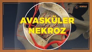 AVASKÜLER NEKROZ TEDAVİLERİ [upl. by Adnamma871]