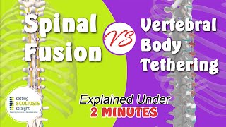 Spinal Fusion vs Vertebral Body Tethering  Explained Under 2 Minutes [upl. by Accalia]