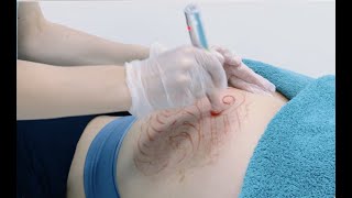 Stretch Mark removal using Microneedling [upl. by Gilbertine655]