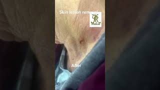 Skin lesion removal [upl. by Ro85]