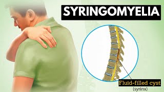 Syringomyelia Everything You Need To Know [upl. by Dunlavy]