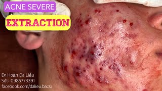 Nặn mụn nhọt ẩn vùng mặt siêu nhiềuSqueeze big pimples hidden acnes full Dr Hoan 0985773391 [upl. by Aikim490]