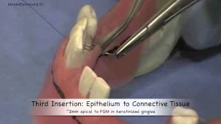 How to Suture Internal Mattress Suture [upl. by Secnirp]