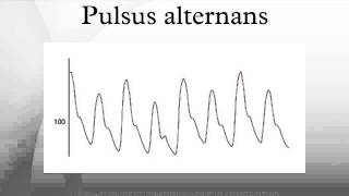 Pulsus alternans [upl. by Naylor405]